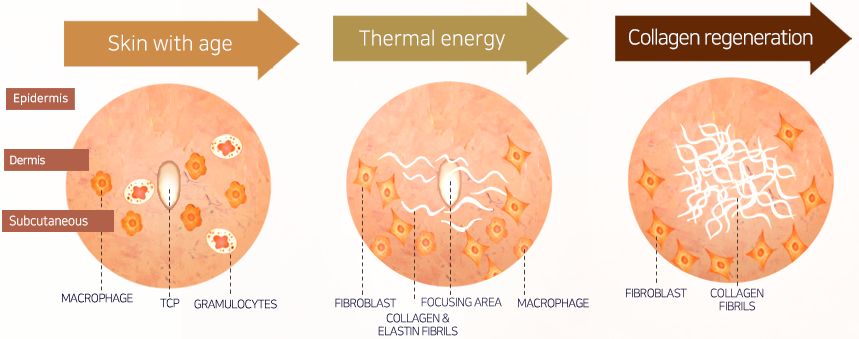 Nguyên tắc tái tạo collagen